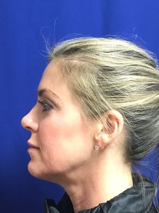 Injectables Minimally-Invasive / Fillers: Case 10 (12012) - Before