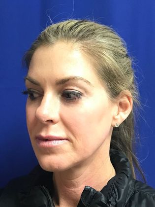 Injectables Minimally-Invasive / Fillers: Case 10 (12012) - After - cheekbones enhanced