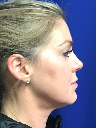 Injectables Minimally-Invasive / Fillers: Case 10 (12012) - Before