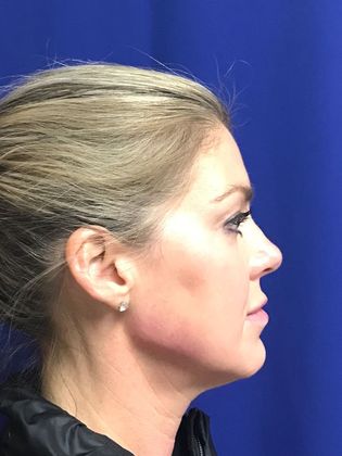 Injectables Minimally-Invasive / Fillers: Case 10 (12012) - After- jawline defined