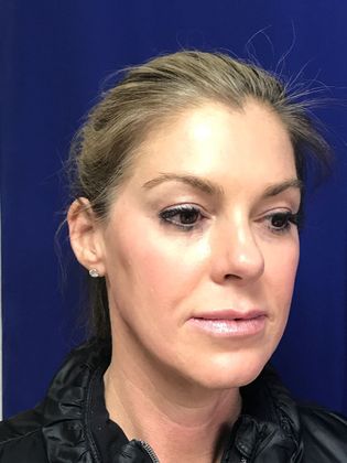 Injectables Minimally-Invasive / Fillers: Case 10 (12012) - After - cheekbones enhanced