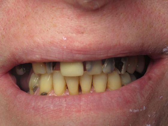 Teeth in a Day: Officer Ronald - Before