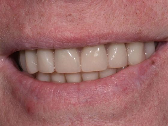 Teeth in a Day: Officer Ronald - After