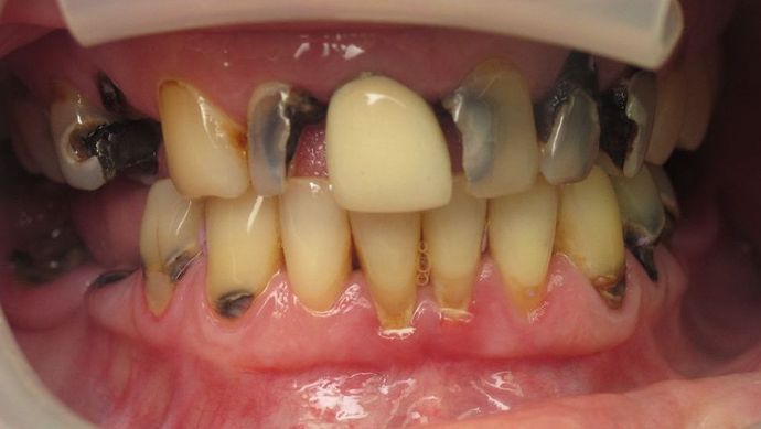 Teeth in a Day: Officer Ronald - Before