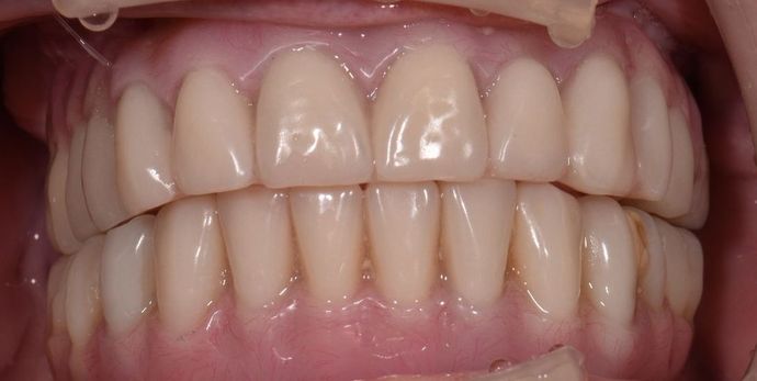 Teeth in a Day: Officer Ronald - After