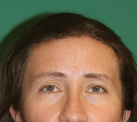 Hairline Lowering Surgery: Case 11 - After