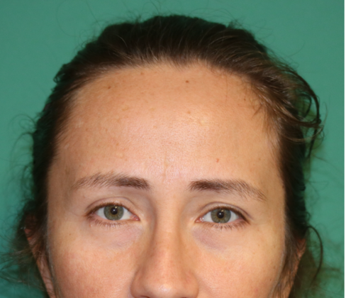 Hairline Lowering Surgery: Case 11 - Before