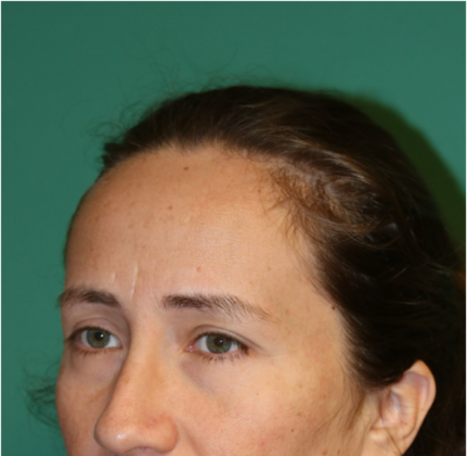 Hairline Lowering Surgery: Case 11 - Before