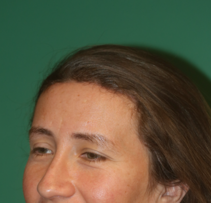 Hairline Lowering Surgery: Case 11 - After