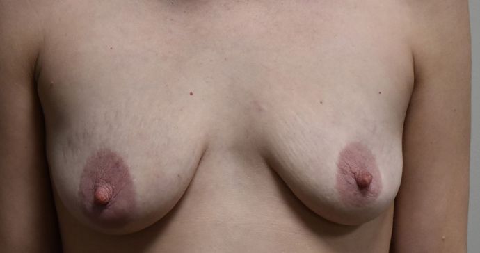 Breast Augmentation Case 539 - Before