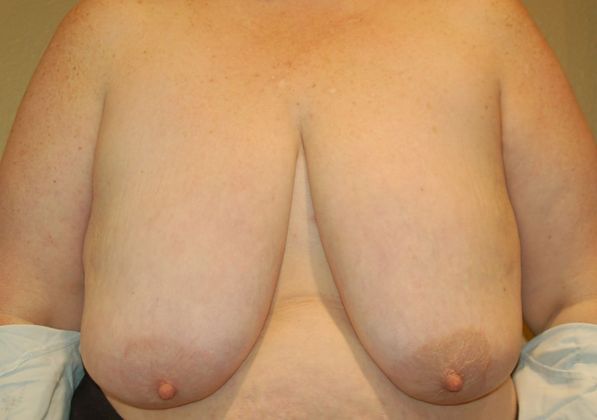 Breast Reduction Case 62 - Before