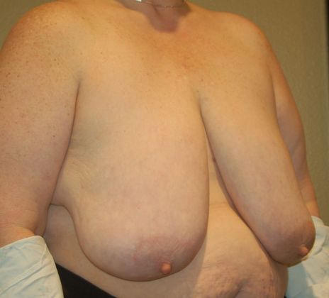 Breast Reduction: Case 62 - Before