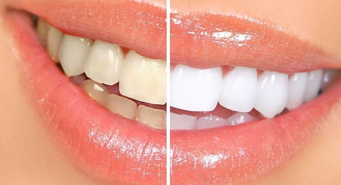 Teeth Whitening Teeth Whitening Cases