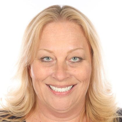 All on 4 Dental Implants Case 11 - After