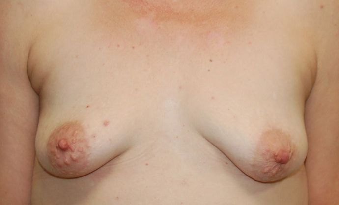 Breast Augmentation w/ Lift Case 255 - Before