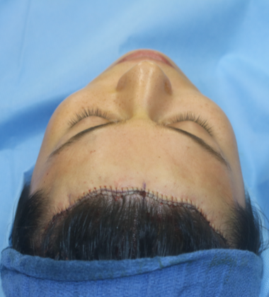Hairline Lowering Surgery: Case 12 - After