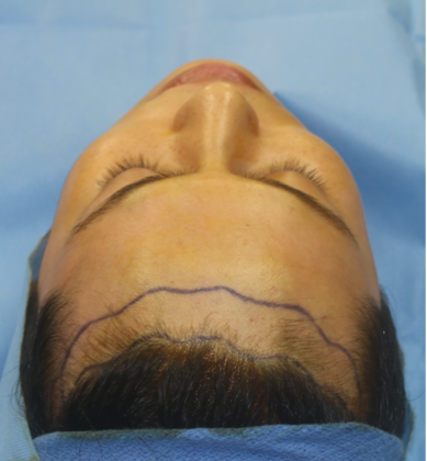 Hairline Lowering Surgery: Case 12 - Before