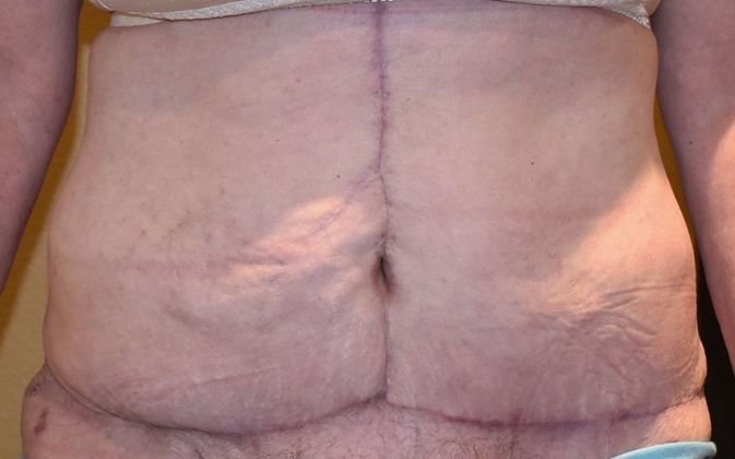 Massive Weight Loss : Case 56 - After