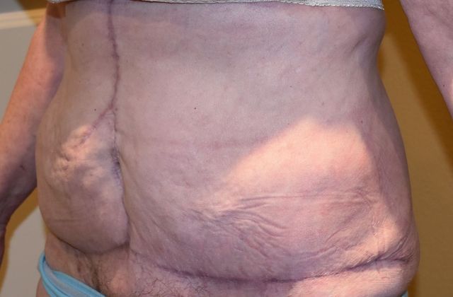 Massive Weight Loss : Case 56 - After