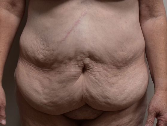 Massive Weight Loss : Case 56 - Before