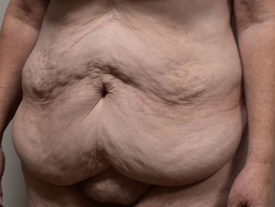 Massive Weight Loss : Case 56 - Before