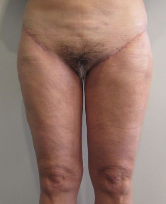 Thigh Lift Case 3 - Inner/Outer Thigh Lift, Westport, CT - After