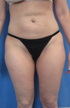 Thigh Lift Case 4 - Inner Thigh Lift, Fairfield - Before