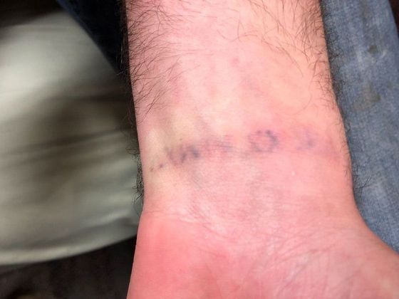 Tattoo Removal : Tattoo Removal 12 - After