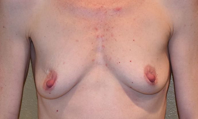 Breast Augmentation Case 543 - Before