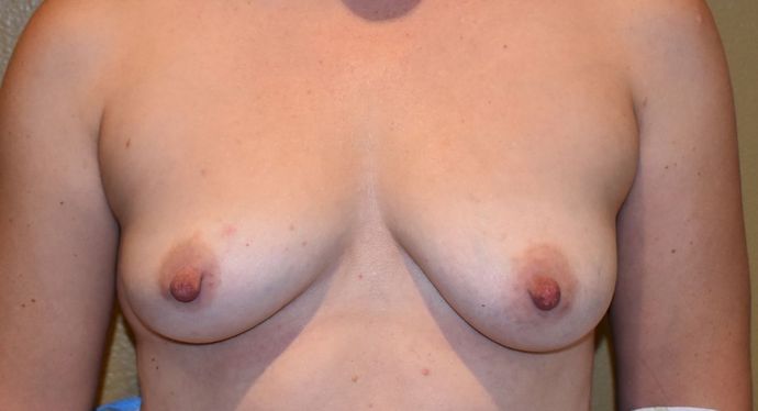 Breast Augmentation Case 545 - Before