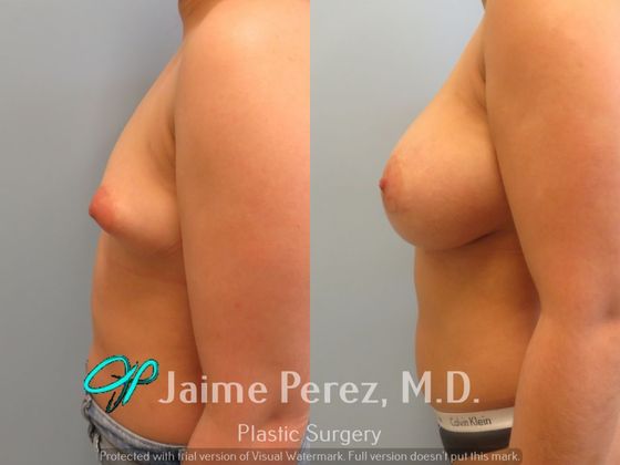 Breast Augmentation: 24-Year-Old Female: Breast Augmentation with 475cc Sil...
