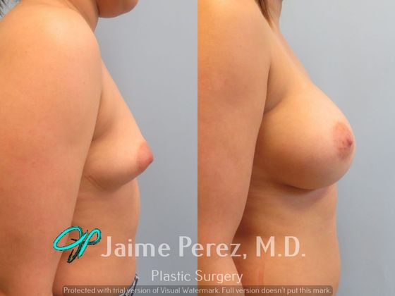 Breast Augmentation: 24-Year-Old Female: Breast Augmentation with 475cc Silicone Implants - Before & After