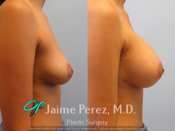 Breast Augmentation: 25-year-old female: Bilateral Breast Hypomastia - Before & After
