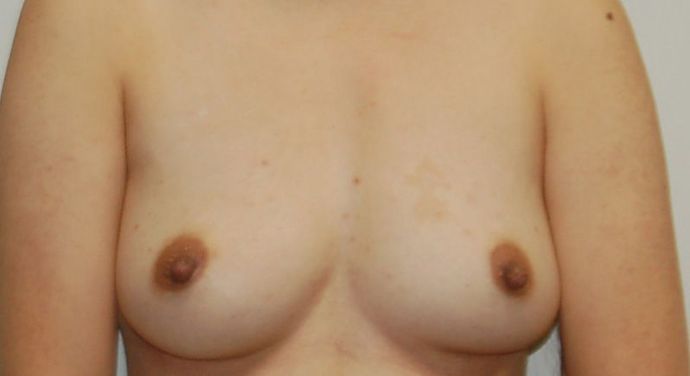 Breast Augmentation Case 546 - Before