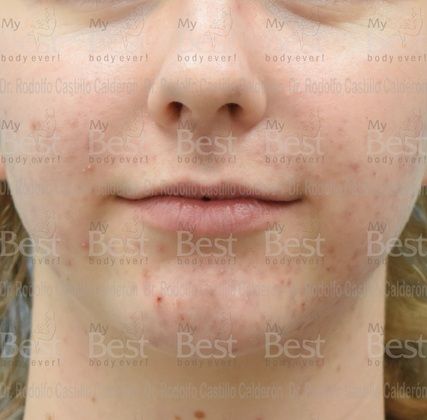 Chin augmentation: Chin Implant with Rhinoplasty and Bichatectomy - Before