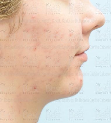 Chin augmentation Chin Implant with Rhinoplasty and Bichatectomy - Before