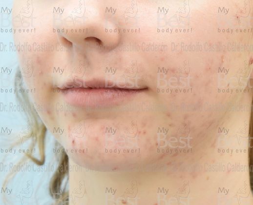 Chin augmentation: Chin Implant with Rhinoplasty and Bichatectomy - Before