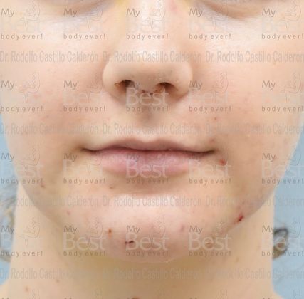 Chin augmentation: Chin Implant with Rhinoplasty and Bichatectomy - After