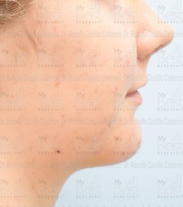 Chin augmentation Chin Implant with Rhinoplasty and Bichatectomy - After