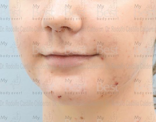 Chin augmentation: Chin Implant with Rhinoplasty and Bichatectomy - After