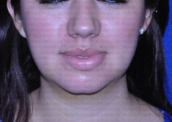 Chin augmentation Chin Augmentation in a patient with microgenia  - After