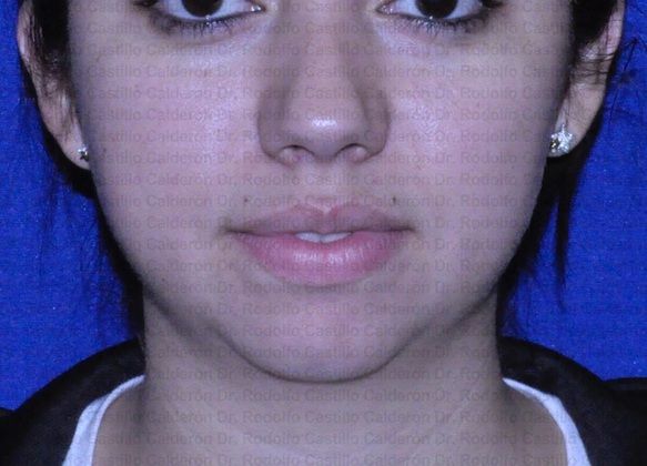 Chin augmentation Chin Augmentation in a patient with microgenia  - Before