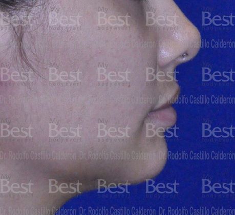 Chin augmentation: Chin Augmentation - After
