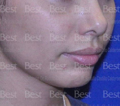 Chin augmentation Chin Augmentation - Before