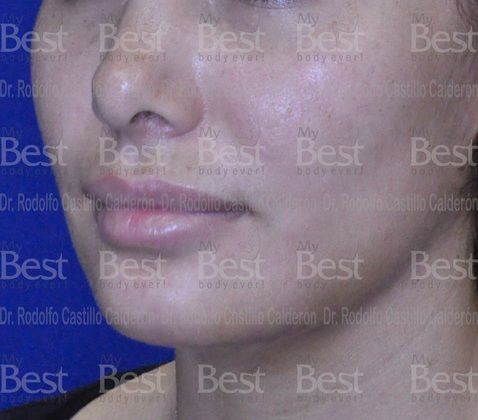 Chin augmentation: Chin Augmentation - After