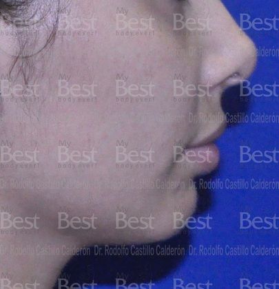 Chin augmentation: Chin Augmentation - Before
