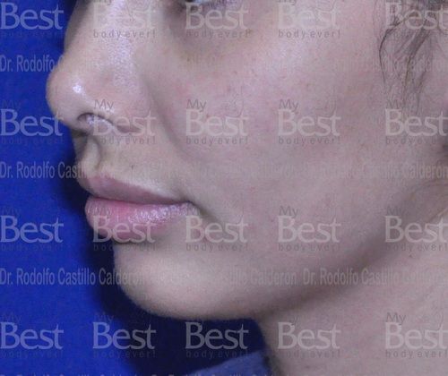 Chin augmentation: Chin Augmentation - Before