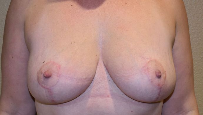 Breast Reduction: Case 63 - After