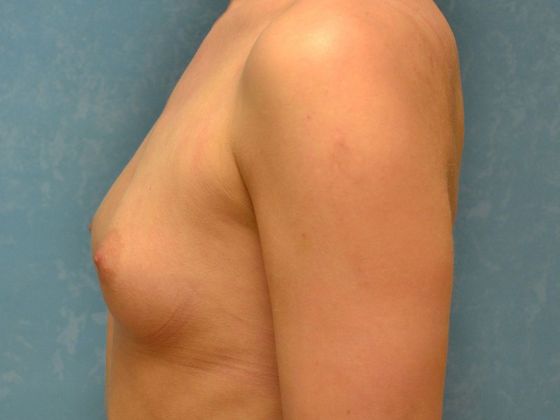 Breast Augmentation: Case 1364- Ottawa Lake, MI - Before