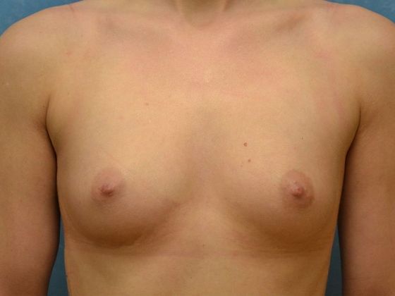 Breast Augmentation Case 1364- Ottawa Lake, MI - Before